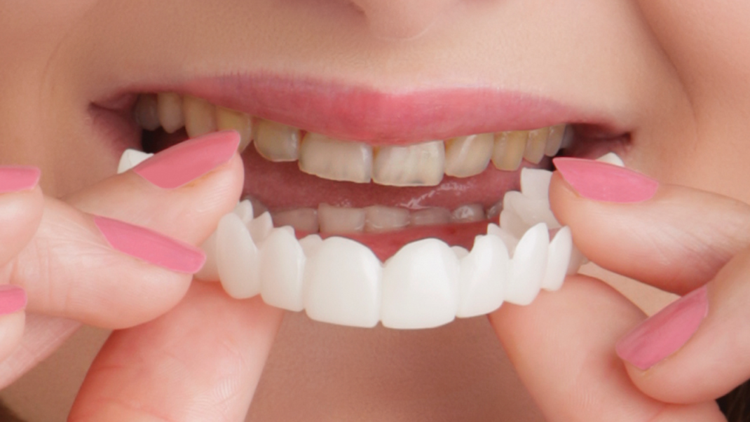 Snap on smile